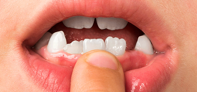 Is Your Teen Complaining about the Shape of Their Teeth?