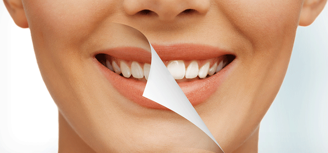 What Is Internal Tooth Bleaching and Are You a Good Candidate?