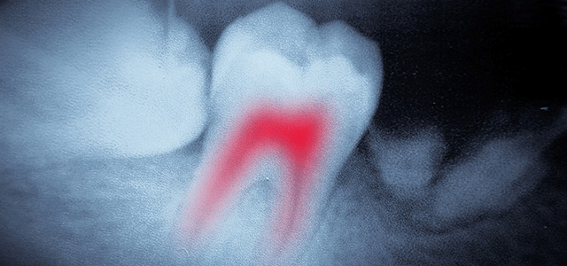 Dental X-Rays: Are They Safe and Necessary?