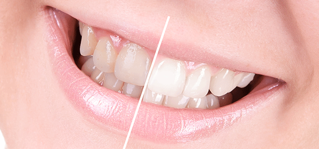 Should You Whiten up Your Holiday Smile at Home?