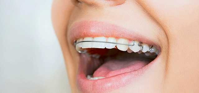 Your Teen's Retainer. Why Wear It, And How To Care For It