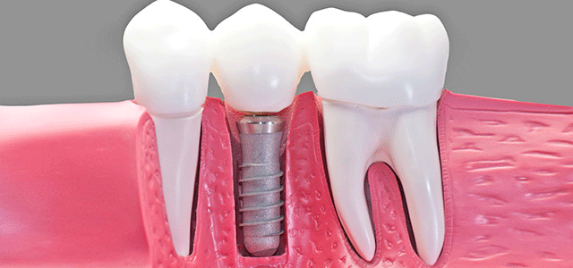 Dental Implants - Getting to the Root of Things